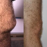 Plumbers knee vs Office Workers knee